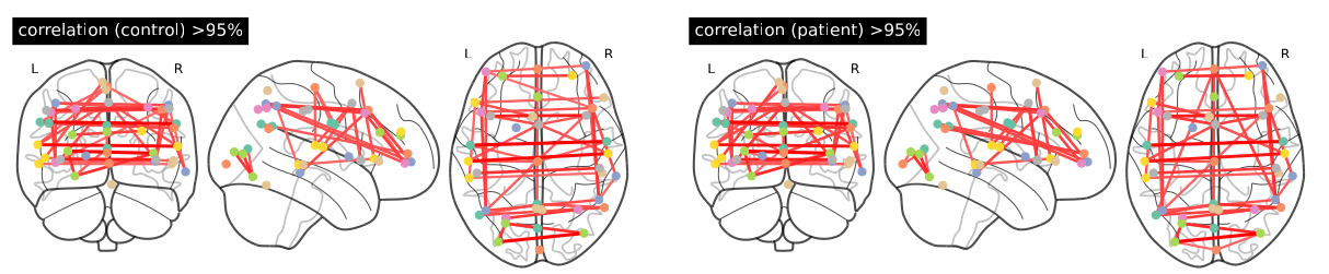 Schizophrenia and Gaze in fMRI